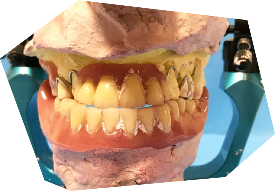 「義歯リマウント調整法」で入れ歯を調整しています。