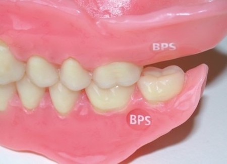 bps義歯